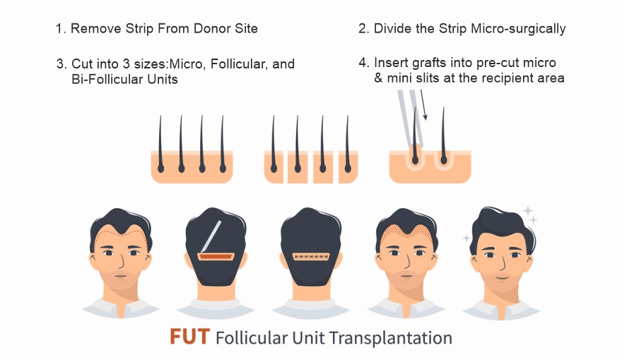 Strip method FUT Hair Transplant
